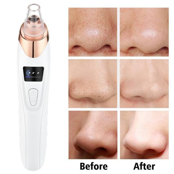 5 in 1 Rechargeable Blackhead Remover - Image 3